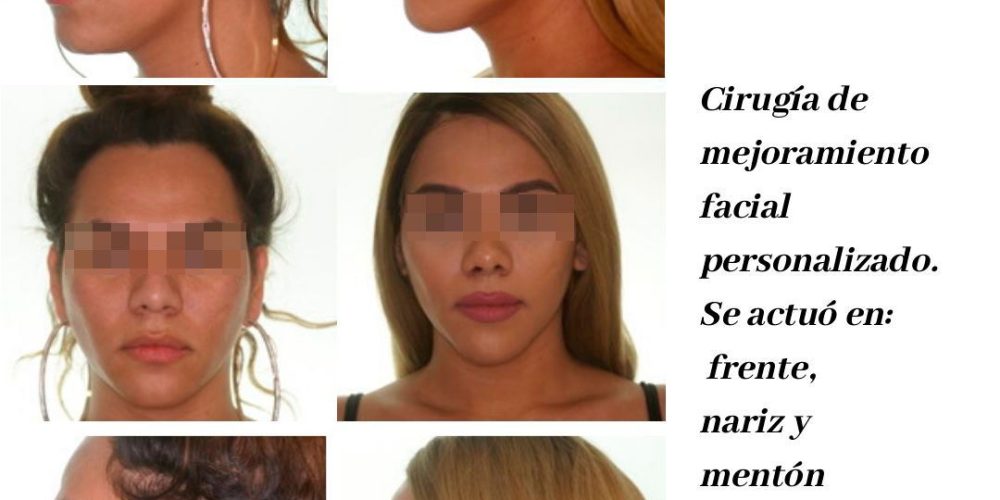 Cirugía de feminización facial