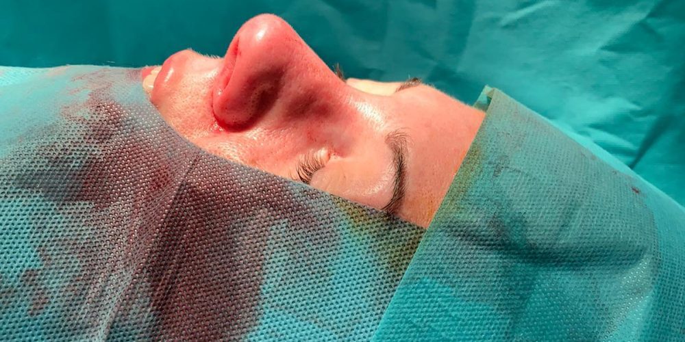 El futuro de la rinoplastia nasal es la rinoplastia ultrasónica