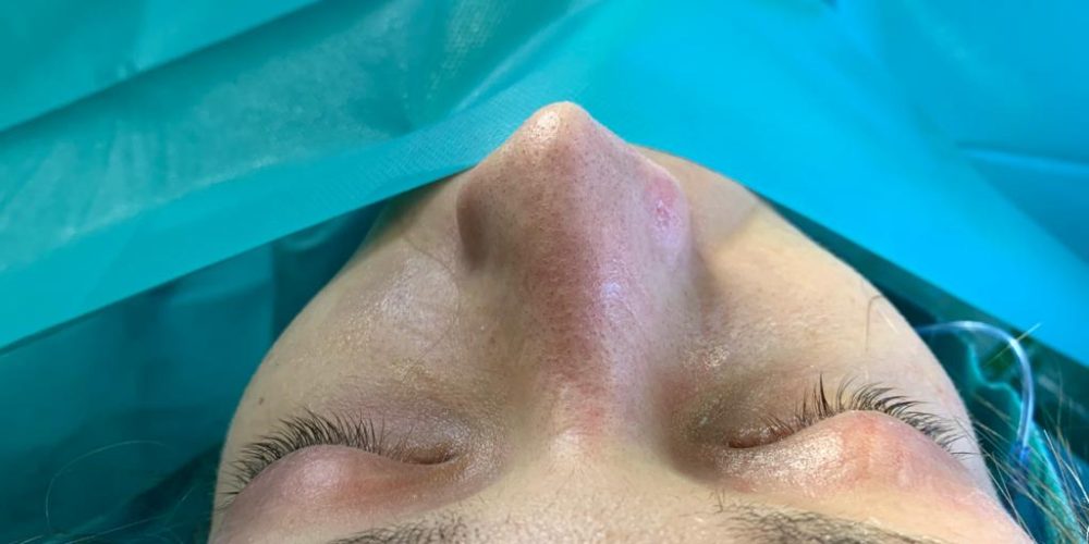 ¿Por qué Elegir la Rinoplastia Ultrasónica? Ventajas y Beneficios