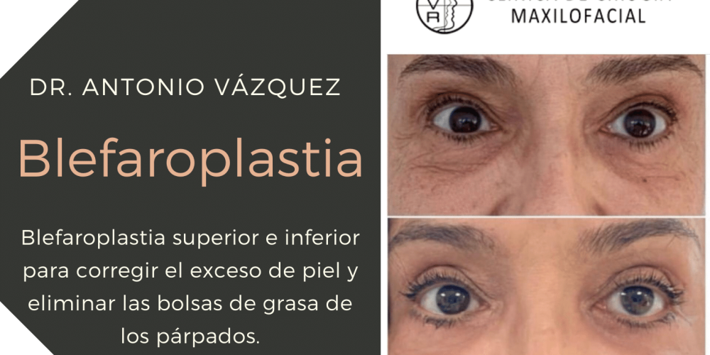 Blefaroplastia superior e inferior