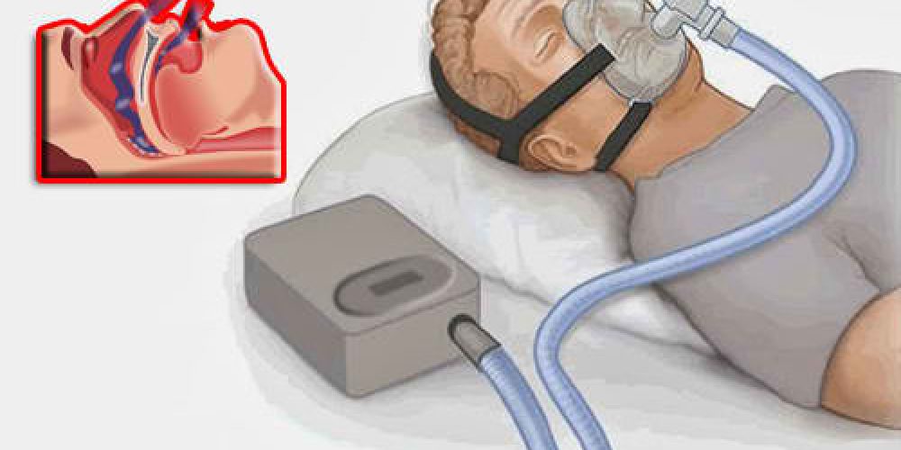 Respiracion con presión positiva (CPAP)