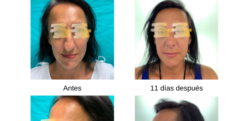 Rinoplastia ultrasónica