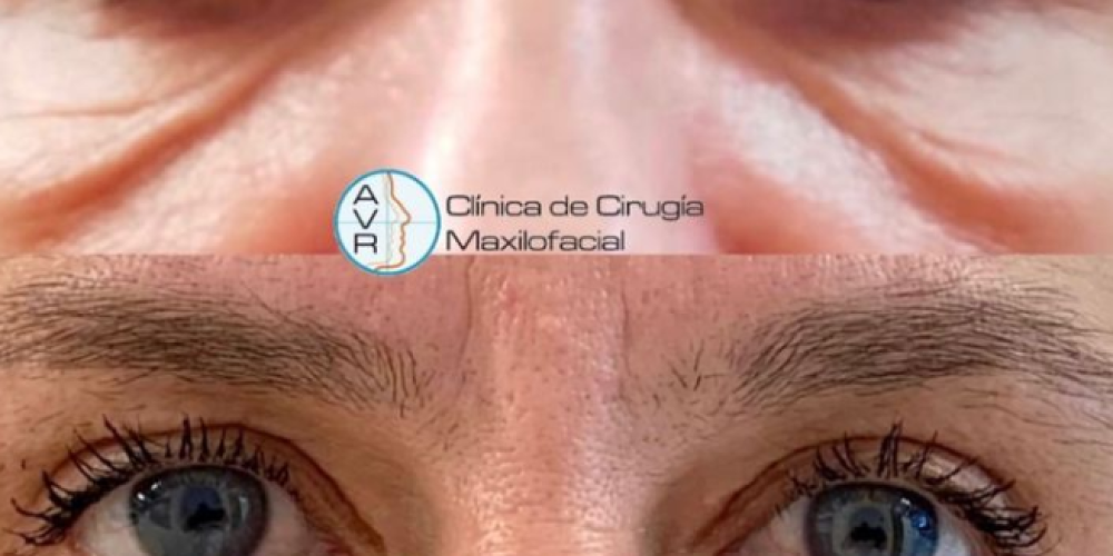 Blefaroplastia superior e inferior