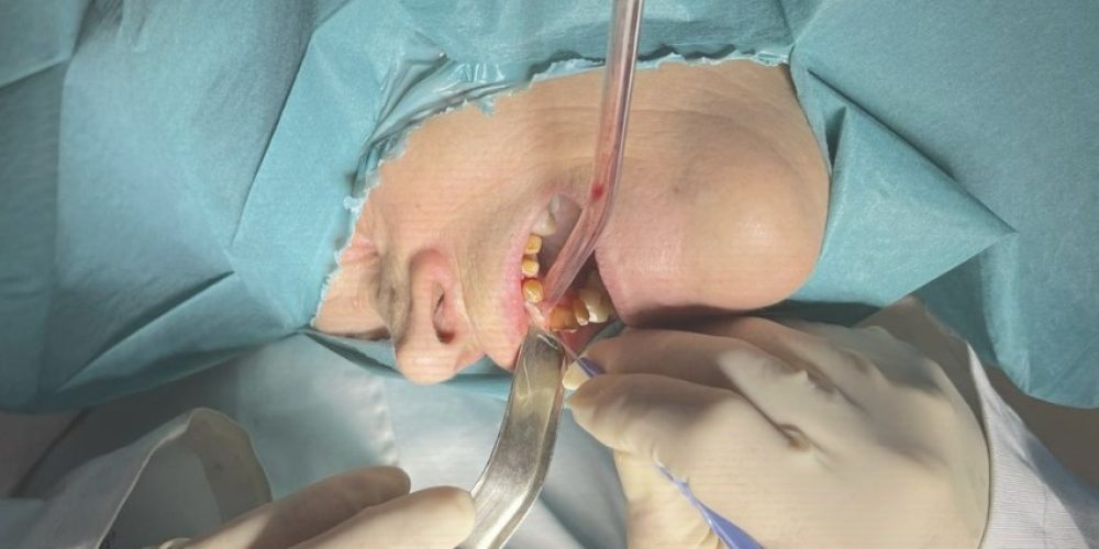 Superando desafíos con una reconstrucción alveolar