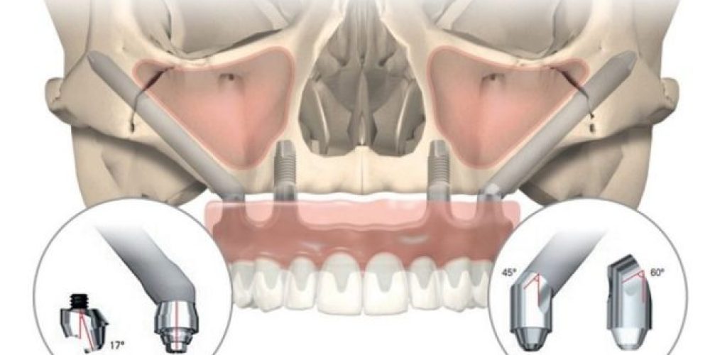 Todo lo que tienes que saber sobre los implantes cigomáticos.