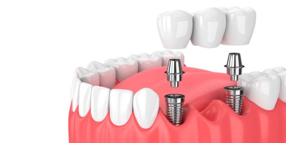 Implantes dentales