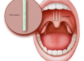 Soft palate implants