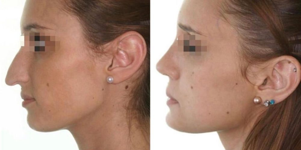 Rinoplastia ultrasónica femenina