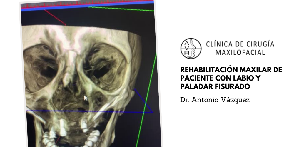 Rehabilitación maxilar de paciente con labio y paladar fisurado