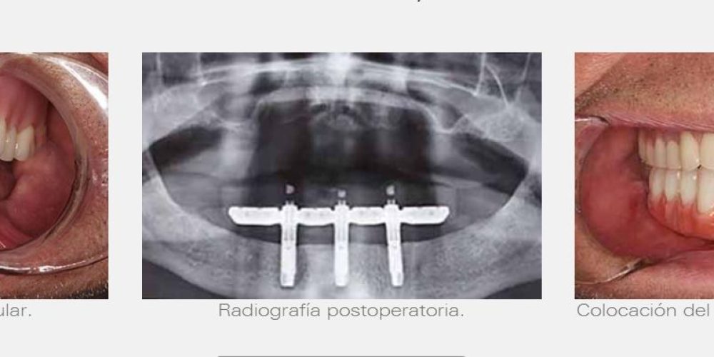 Trefoil, definitive teeth in hours with a single intervention