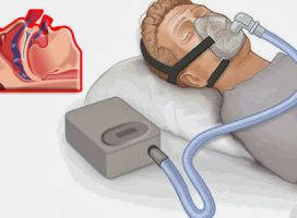 CPAP (Continuous Positive Airway Pressure)