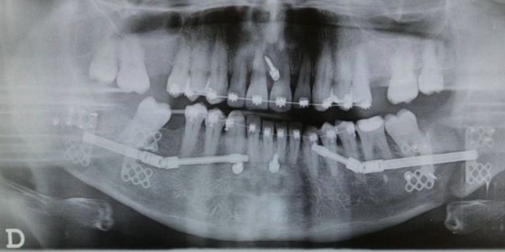 Tratamiento de la apnea de sueño