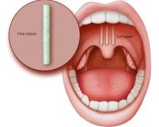 Soft palate implants