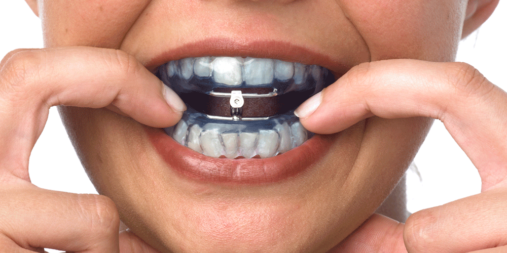 Férulas de avance mandibular (MAD)