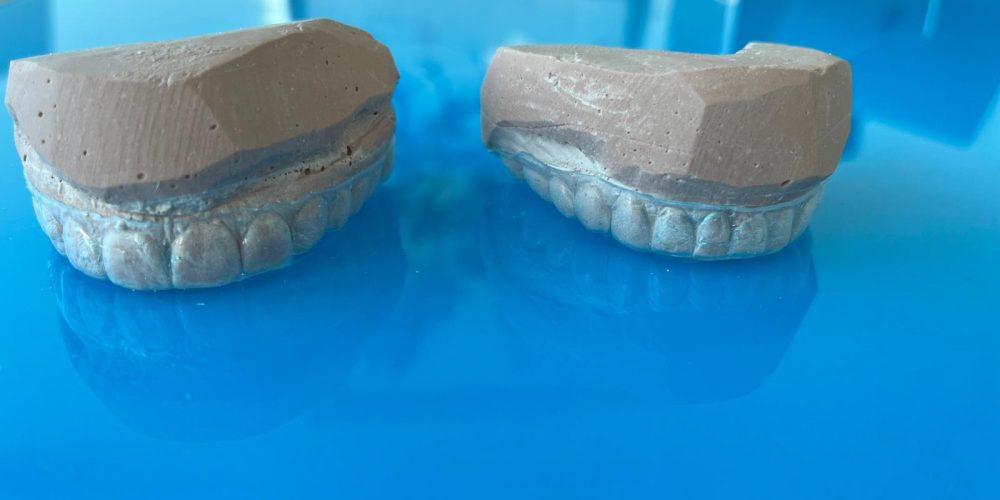 Férulas de blanqueamiento dental personalizadas desde casa