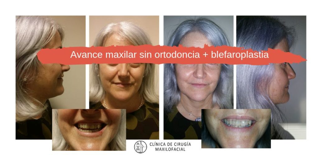 Avance maxilar sin brackets ni ortodoncia