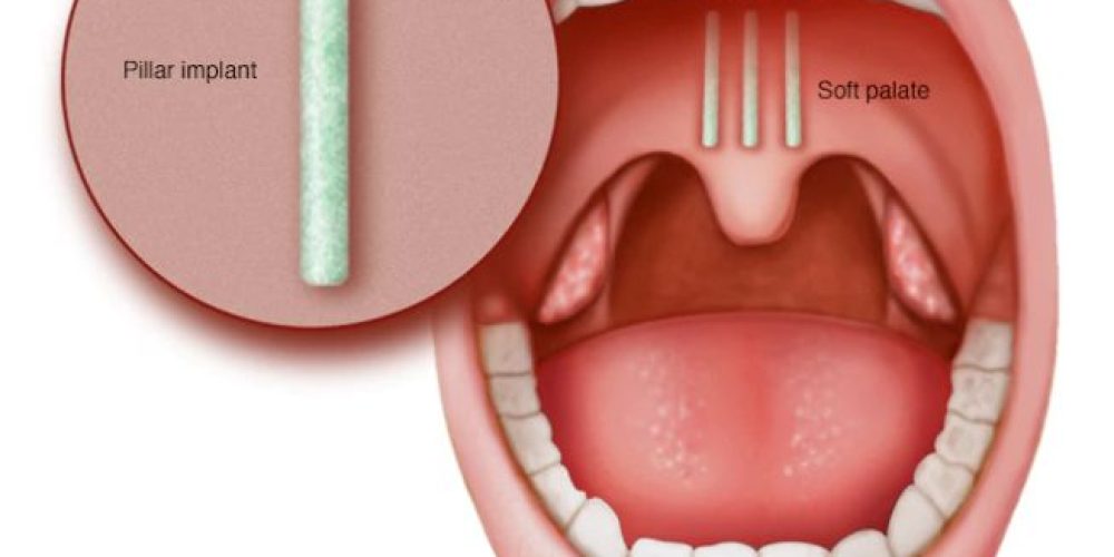 Implantes de paladar blando