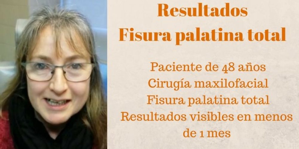 Resultados de una cirugía de fisura palatina en Barcelona