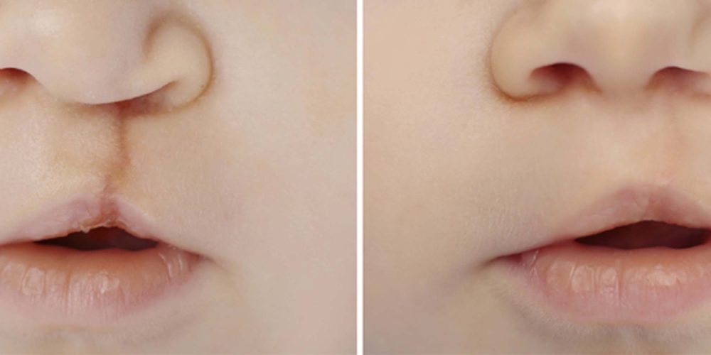Transformando vidas a través de la cirugía de Labio Leporino