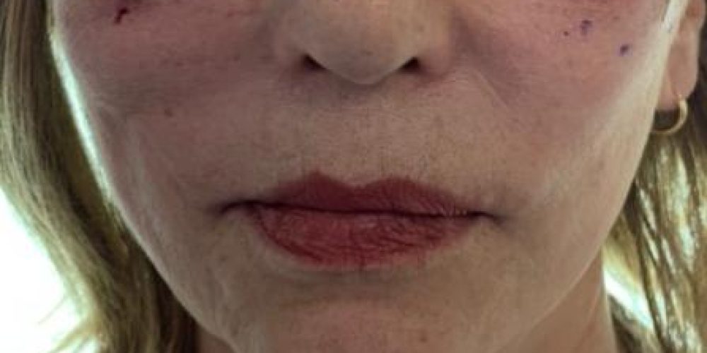 Lifting medio con anestesia local